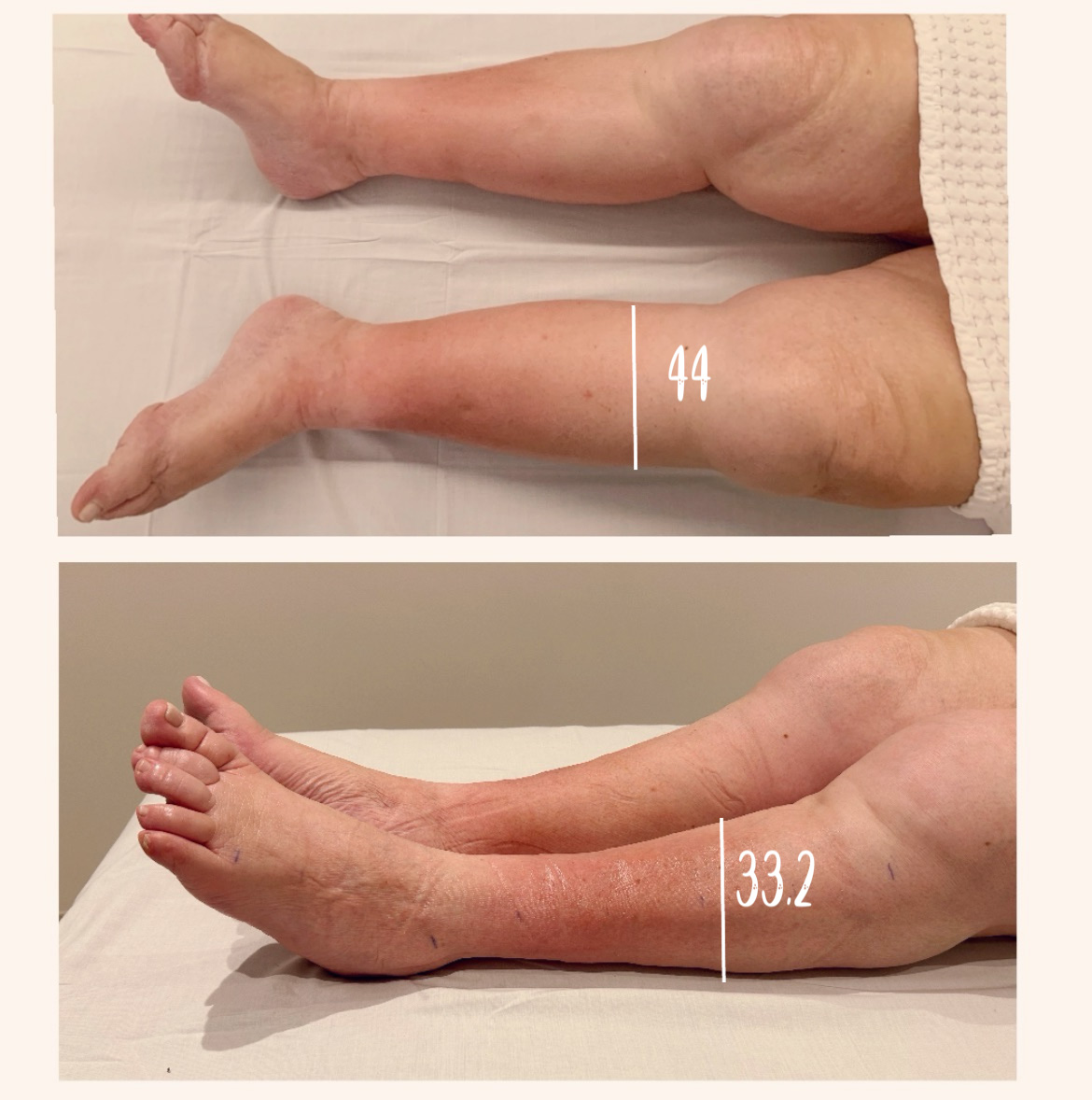 Linfedema - Centro Vodder