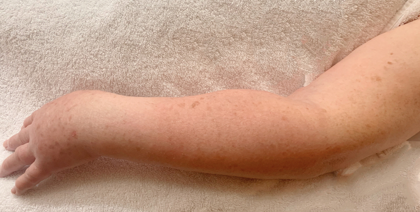 Linfedema - Centro Vodder
