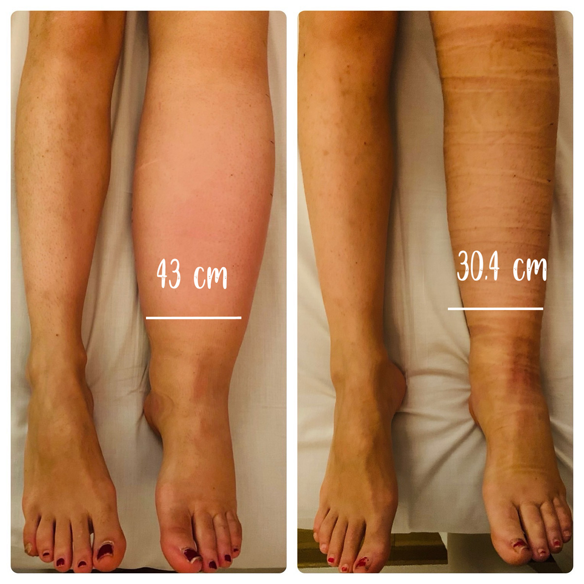 Linfedema - Centro Vodder
